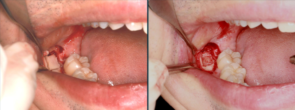 Figure 2: Carving a rectangular bone window to expose the crown of tooth 48, and the rectangular bone cap was soaked in normal saline for standby