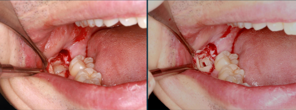 Figure 3: Removing the resistance of the crown by "T"-shaped crown sectioning