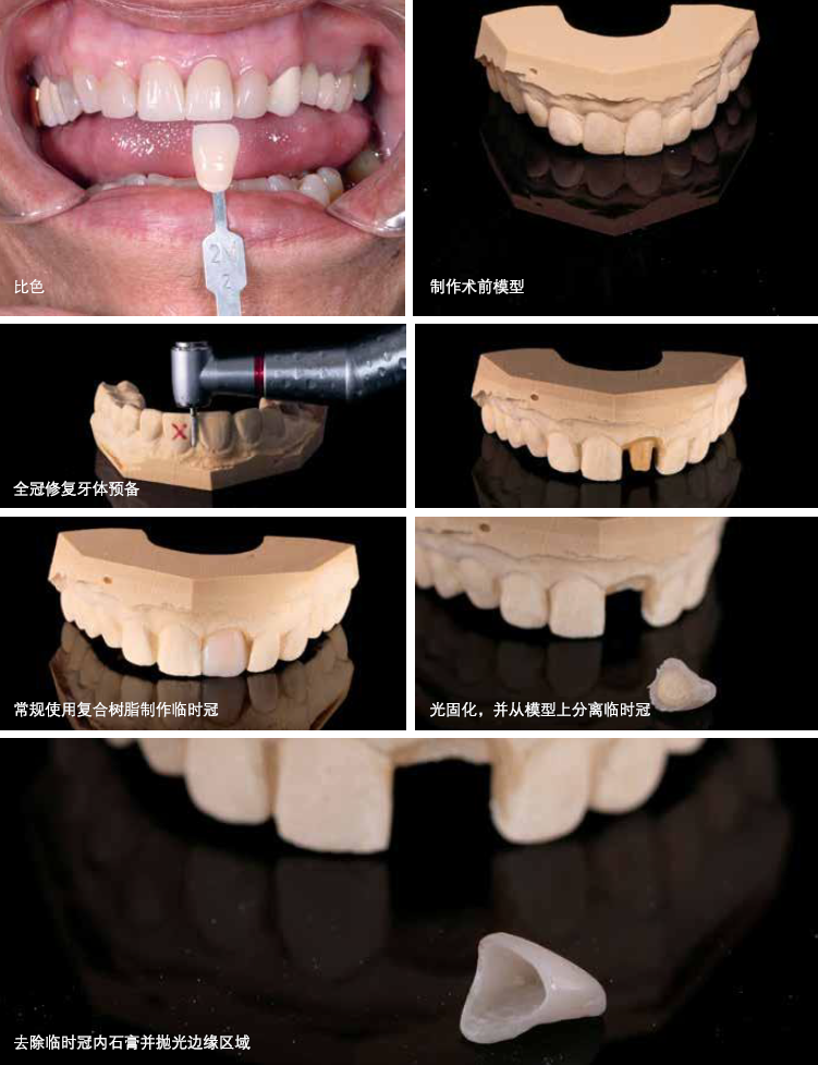 Fabrication of composite resin temporary crown