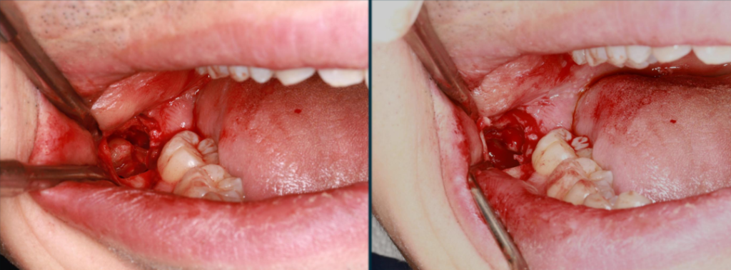 Figure 4: Cleaning, curetting, and irrigating the extraction socket after elevating the crown