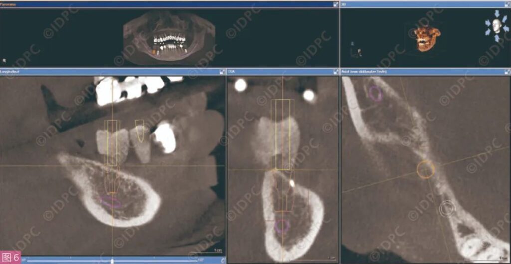 - Figure 6: CBCT Implant Planning (Site 46).