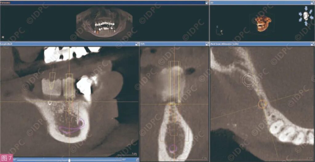 - Figure 7: CBCT Implant Planning (Site 45).