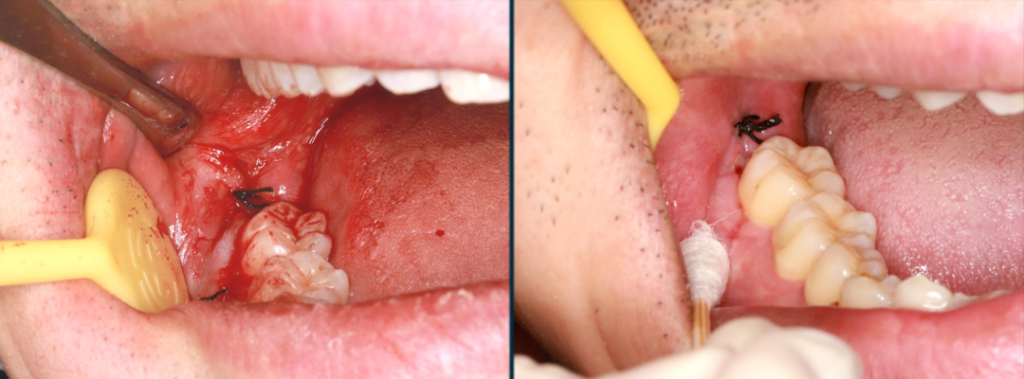 Figure 7: Suturing the wound and removing the stitches for reexamination one week later