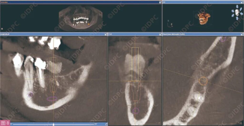 - Figure 8: CBCT Implant Planning (Site 36).