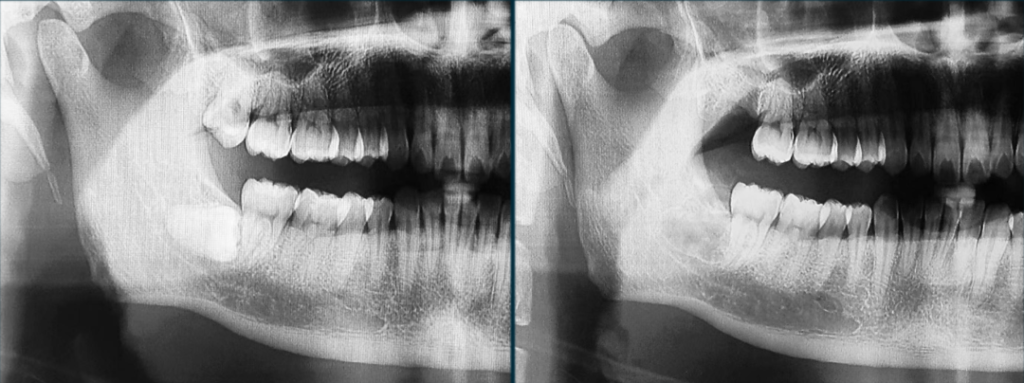 Figure 8: Comparison of panoramic radiographs before and after the operation