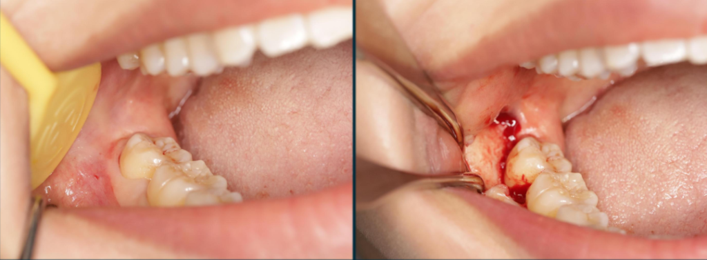 Figure 9: Raising an angulated flap to expose the bone surface of the surgical area