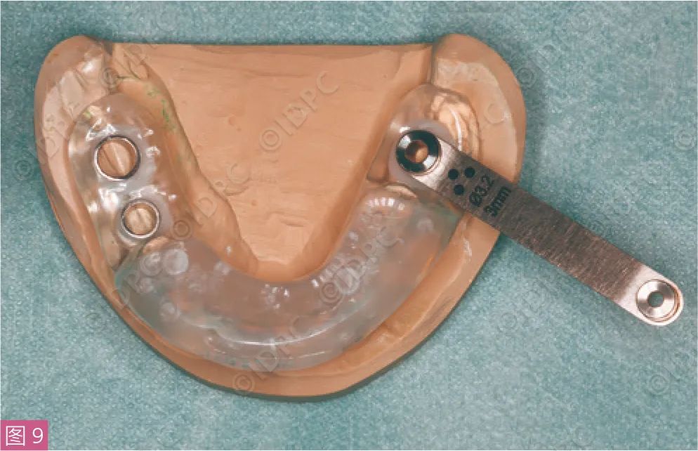 Figure 9: Implant Guide Guided Implantation.